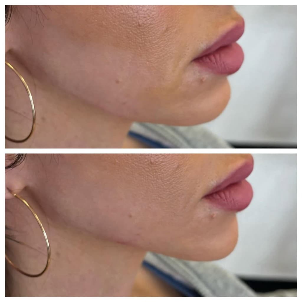 Dermal Filler at Artful Aesthetic Medicine, Englewood CO.