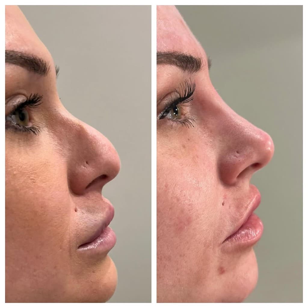 Non-Surgical Nose Job at Artful Aesthetic Medicine, Englewood CO.